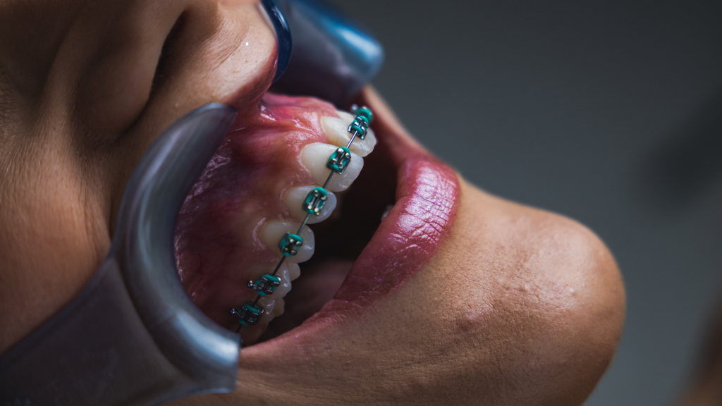 Aparelhos Dentários
